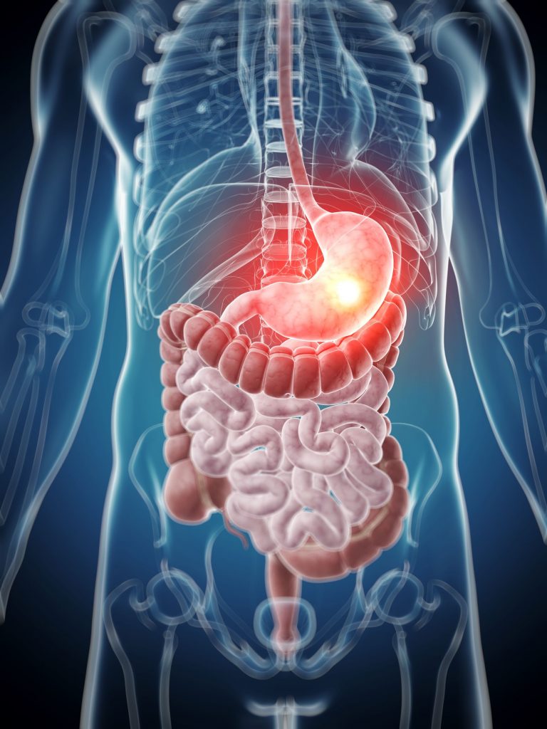 18071399 - 3d rendered illustration - painful stomach